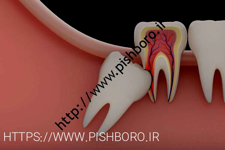 هر آنچه درباره دندان عقل باید بداند